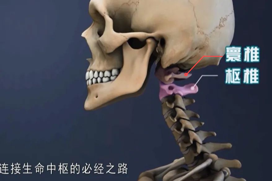 【案例分享】顱底凹陷、寰樞椎脫位，你了解多少？