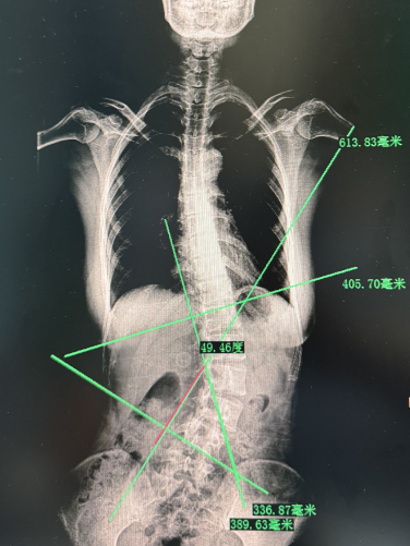 什么！脊柱矯正還能長(zhǎng)高？